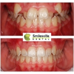 Invisalign Treatment Christchurch