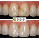 Teeth Bonding Procedure Christchurch.Cosmetic Dentists Christchurch. Smilesville Dental, Riccarton Road Christchurch.