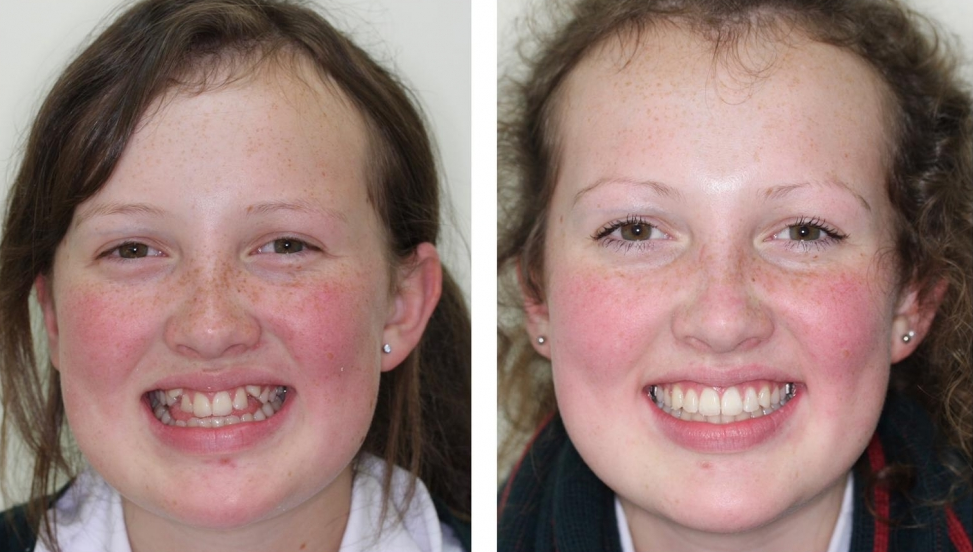 Invisalign Teeth Straightening Christchurch call the Cosmetic Dentists Christchurch, Smilesville Dental